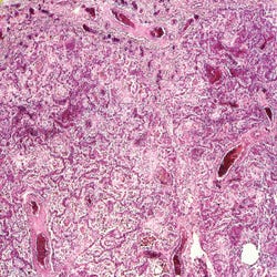 Image for Johannes Lieder Prepared Slide, Human Carcinoma Lung Cancer from School Specialty